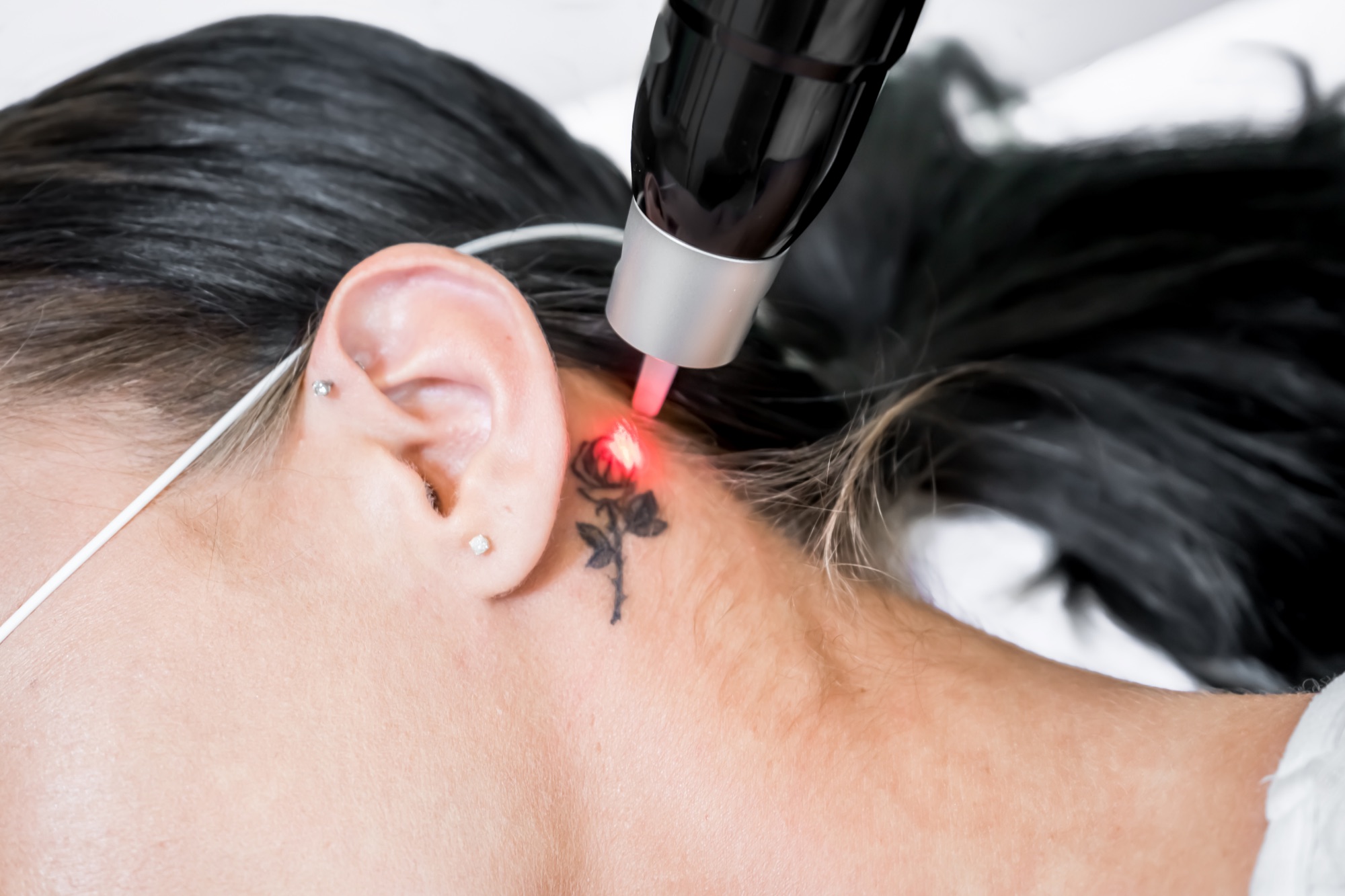 Laser Tattoo Removal of a small tattoo behind a woman's ear