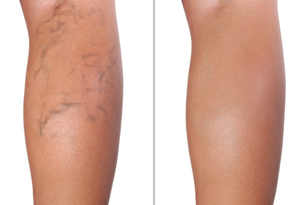 before and after spider vein removal
